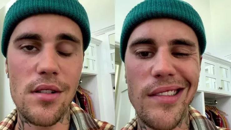 Justin Bieber yüz felci geçirdi