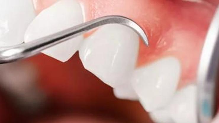 Diş eti hastalıkları diş kaybına neden oluyor