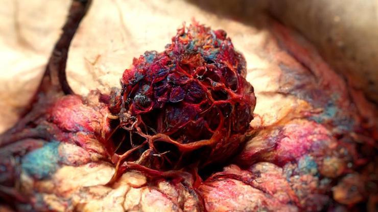 Karaciğer kanseri vücuda yayılması durumunda tedavi edilebilir mi
