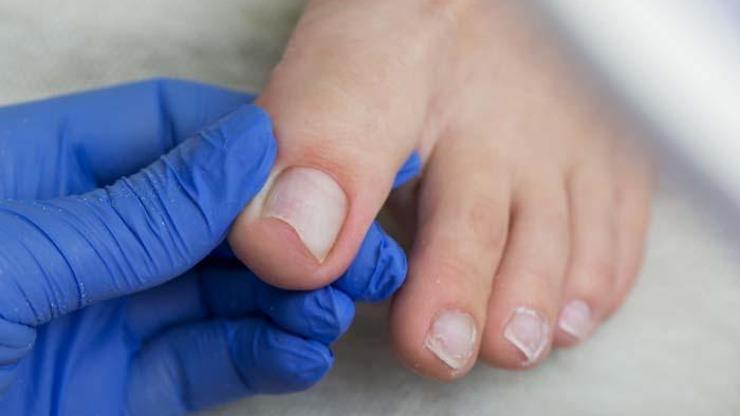Yanlış Tırnak Kesimi Diyabet Hastaları İçin Büyük Risk Uzmanlar Uyardı