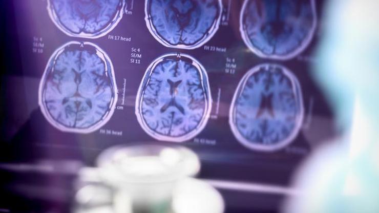 Alzheimer tedavisinde yeni umut: Hastalığın beyindeki tahribatını yavaşlatan ilk ilaç