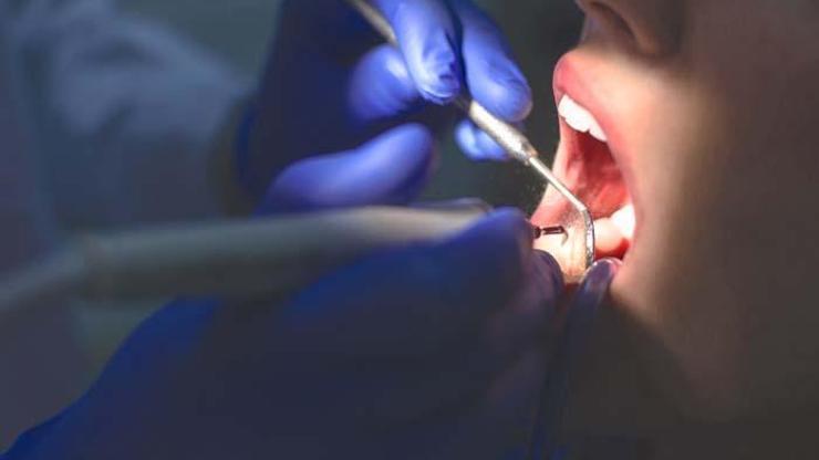 Diş çürükleri ağız içi kanserine neden olabilir Ağız içi kanserlerinin nedenleri