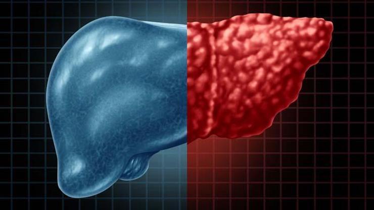 Açıklanamayan kilo kaybı ve üst karın ağrısı karaciğer kanserini işaret ediyor Karaciğer kanserini önleyici tavsiyeler