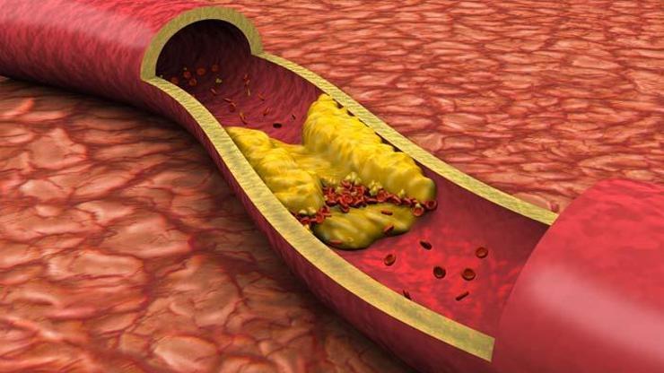 Yüksek kolesterole karşı 5 etkili öneri