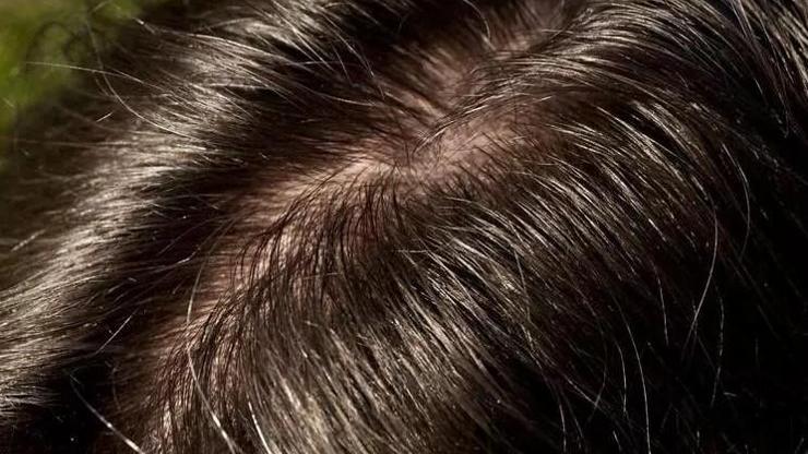 Eksikliği Saçlarda Yoğun Kepek Ve Kaşıntıya Neden Oluyor Sağlık Haberleri 0047