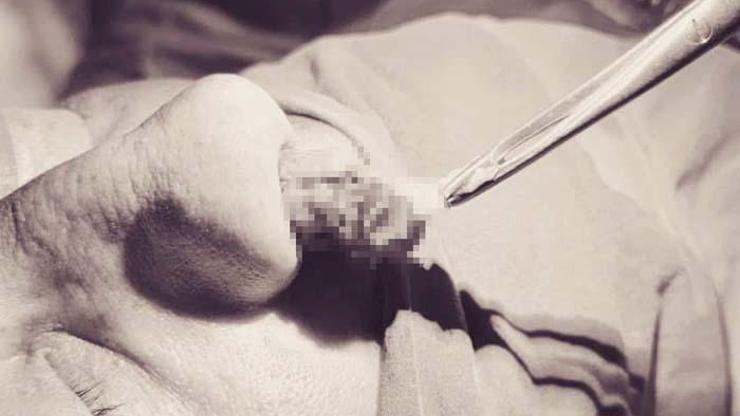 Nefes almada zorluk yaşayan 50 yaşındaki hastanın burnundan 8 santimetrelik kitle alındı
