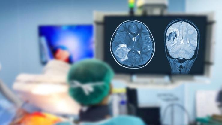 Ameliyata giren doktorlar şokta: Beyninden 8 cmlik solucan çıktı