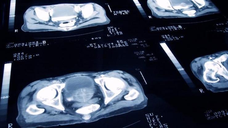Prostat kanseri: Yeni bir deney, radyoterapi dozlarının büyük ölçüde azaltılabileceğini ortaya koydu