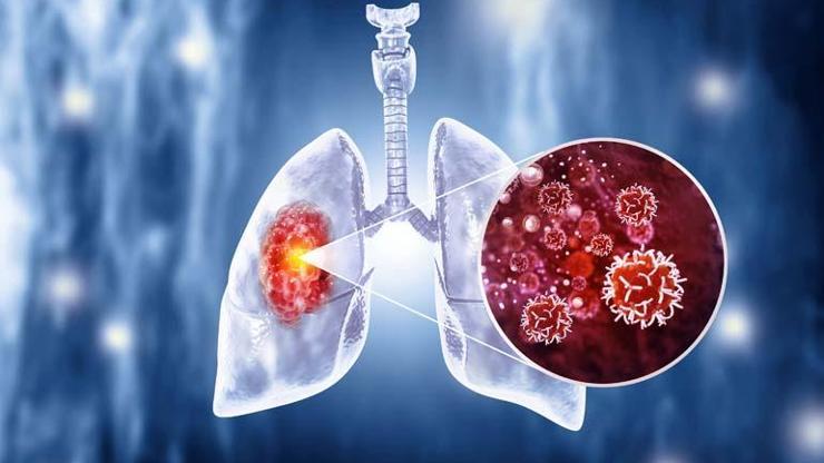 Akciğer kanseri riski o kişilerde 30 kat daha fazla İşte akciğer kanserinin en önemli belirtisi