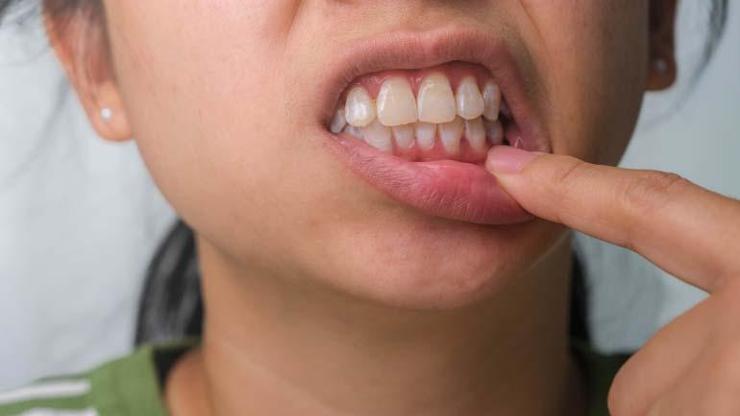 Bu hatalar ağız hijyenini bozuyor Protezini çamaşır suyunda bekletenler, dişlerini sürekli karbonatla fırçalayanlar dikkat