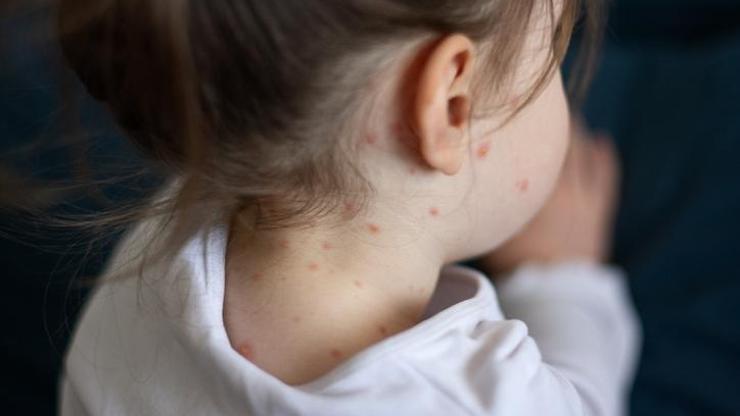Vakalar artıyor, çocuğunuzun kızamık aşısını ihmal etmeyin