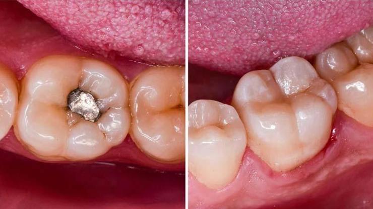 Avrupada yasaklandı Diş dolgusu yaptıracaklar dikkat: Beyin, sinirler ve böbrek hasarına yol açıyor