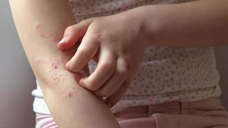 Besin alerjisi her 17 çocuktan birini etkiliyor