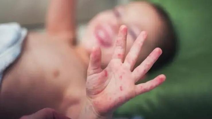 Çocuklarda el, ayak ve ağız hastalığı kabusu: Parklarda bulaşabilir