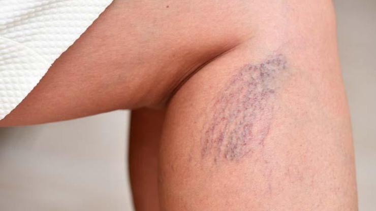 Bacaklarınızdaki kılcal damarları hafife almayın: Varis sessiz ilerliyor