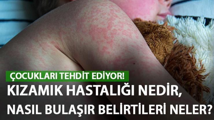 Kızamık nedir, nasıl bulaşır Kızamık belirtileri nelerdir, tedavisi nasıl yapılır