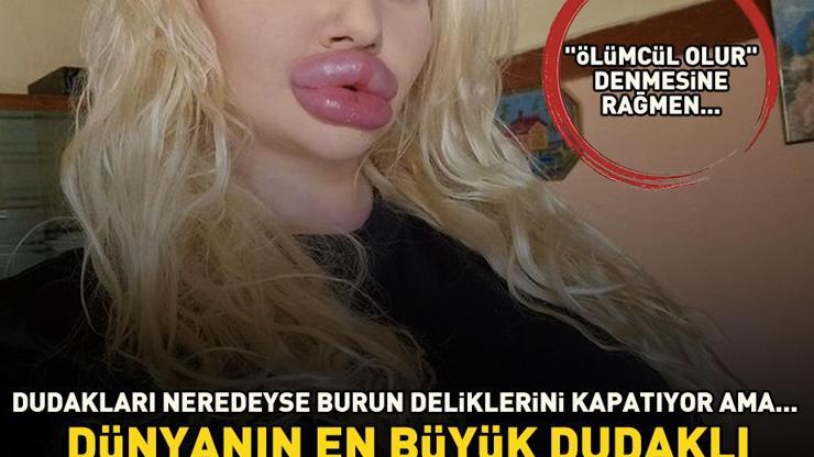 Dünyanın en büyük dudaklı kadını yine şoke etti Doktorlar Daha fazla estetik ameliyat ölümcül olur dedi ama...