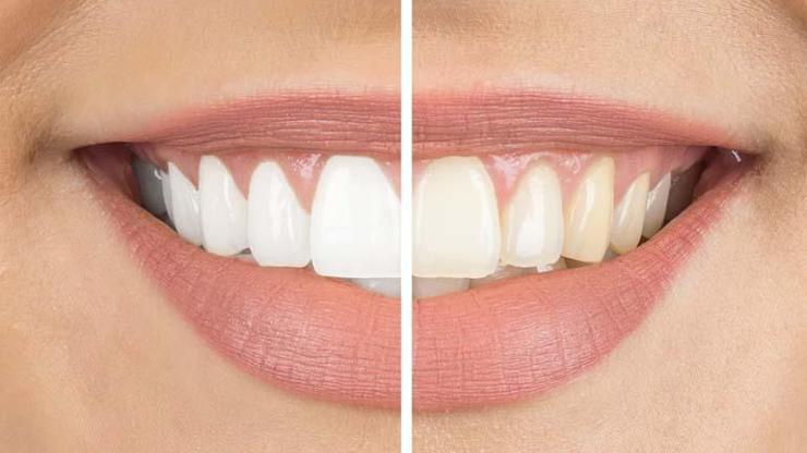 Bilinçsiz diş beyazlatmalara dikkat: Kalıcı hasara neden olabilir