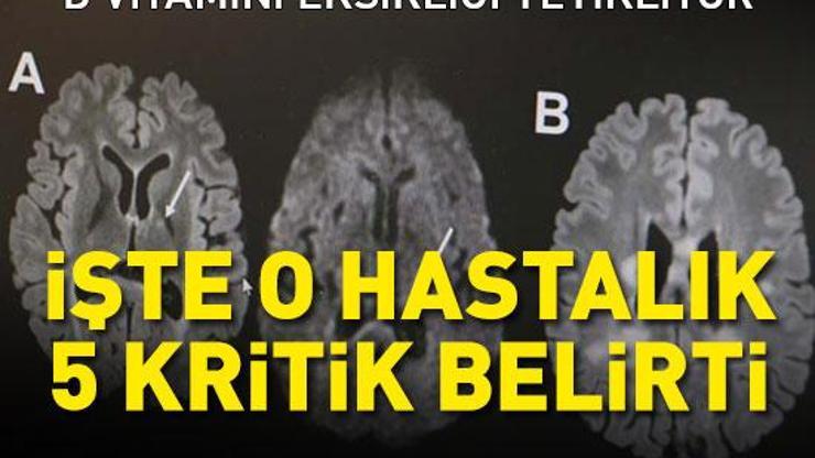 D vitamini eksikliği tetikliyor: Dünyada 3 milyon, Türkiyede 60 bin hasta var 5 kritik belirtiye dikkat