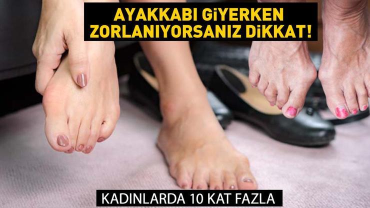 Ayak başparmağındaki eğrilik ve bu 5 belirtiye dikkat Kadınlarda 10 kat daha fazla...