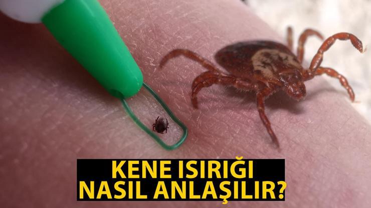 Kene ısırığı belirtileri: Kene ısırığı nasıl anlaşılır, ilk yapılması gereken nedir