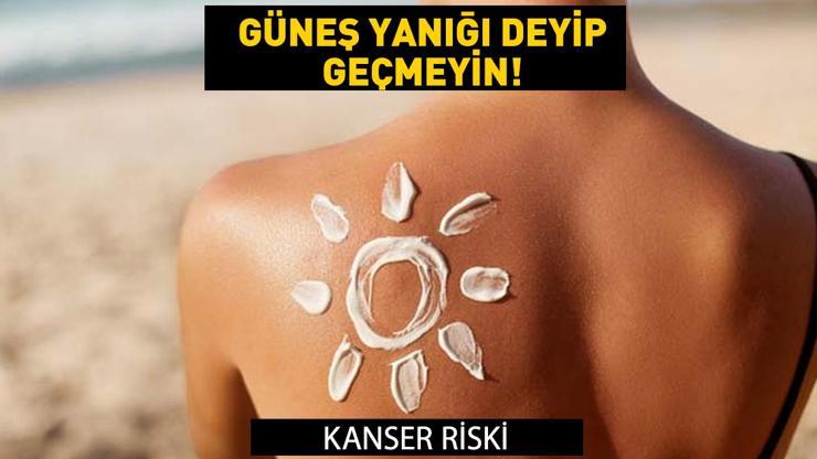 Güneş yanığı deyip geçmeyin Kanseri riski... Güneş yanığına ne iyi gelir