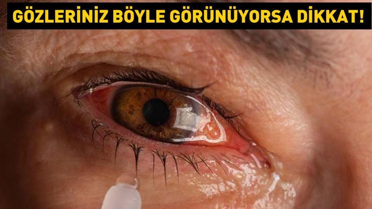 Gözleriniz böyle görünüyorsa dikkat Çiğ etten bile bulaşabiliyor 3 kritik belirti ile başlıyor... Tedavi edilmezse görme kaybına yol açıyor