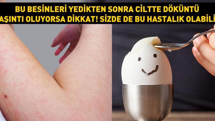 Bu besinleri yedikten sonra ciltte döküntü, kaşıntı varsa aman dikkat Sizde de bu hastalık olabilir... Bazen belirti vermiyor