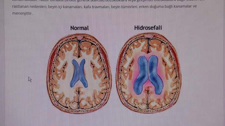 Beyin Cerrahı Uzmanı uyardı: Hidrosefali, erken teşhis konulmazsa ölüme sebebiyet verebilir