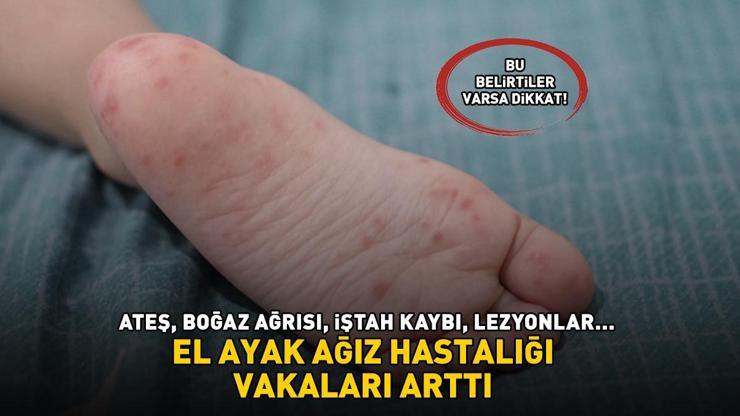 EL AYAK AĞIZ HASTALIĞI VAKALARI ARTTI, HASTANELER DOLDU TAŞTI Ateş, boğaz ağrısı, iştah kaybı, lezyonlar... Bu belirtiler varsa dikkat