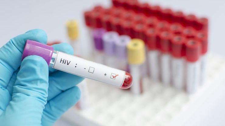 HIV POZİTİF NE DEMEK HIV nedir, nasıl bulaşır HIV ölümcül mü