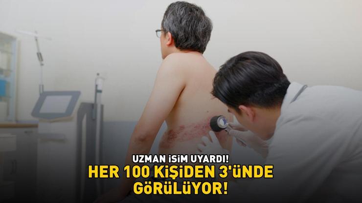 HER 100 KİŞİDEN 3ÜNDE GÖRÜLÜYOR Uzman isim uyardı: 85 yaşına kadar hastalığa yakalanma riski yüzde 50’