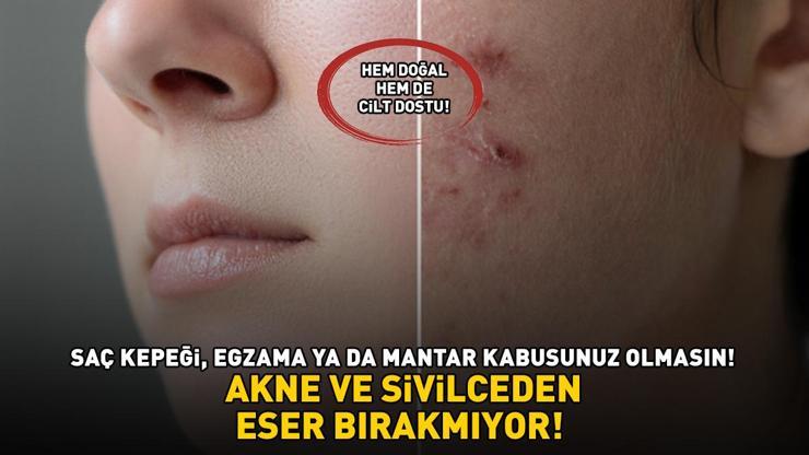 AKNE VE SİVİLCEDEN ESER BIRAKMIYOR Kilosu 700, 1 tanesi 50 TL Cilt dostu: Saç kepeği, egzama ile mantar kabusunuz olmasın