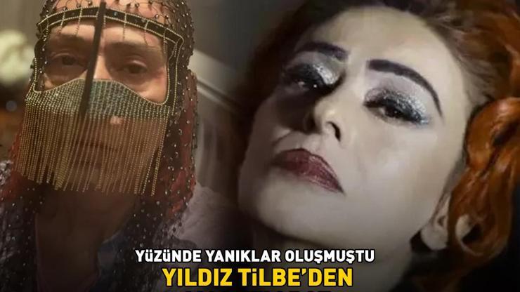 Yüzünde yanıklar oluşmuştu YILDIZ TİLBEDEN MASKELİ POZ