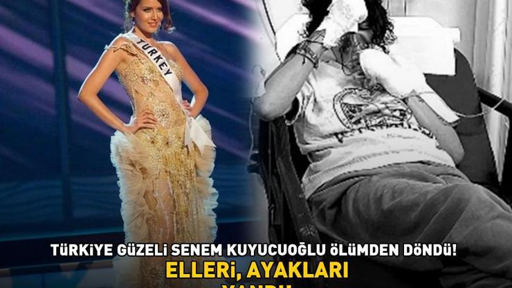 Türkiye Güzeli Senem Kuyucuoğlu ölümden döndü ELLERİ, AYAKLARI YANDI