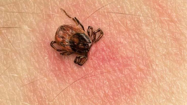 Çocuklarda keneye karşı vücut kontrolü uyarısı Özellikle kulak arkası, ense, saç ile örtülü alanlara dikkat