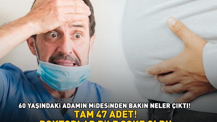 TAM 47 ADET 60 yaşındaki adamın midesinden bakın neler çıktı Doktorlar bile şaştı kaldı