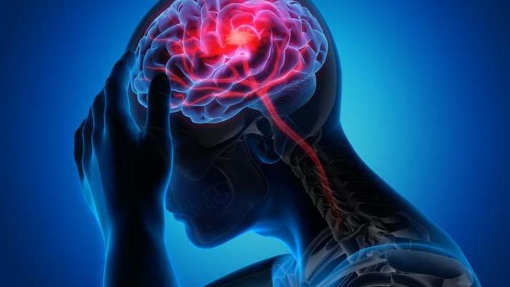 Çağın Kabusu: Beyin Damarlarında Birikerek Kan Akışını Engelliyor Alzheimer, Demans, İnme... Zihinsel Hastalıklarda Vakalar Patladı Mikroplastikler Beyinde Nasıl Birikiyor