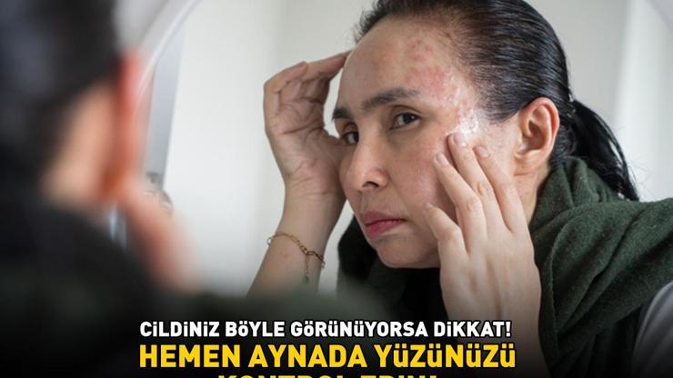 Hemen aynada yüzüne bakın Eğer cildiniz böyle görünüyorsa dikkat Sağlıksız bağırsakların 6 uyarı işareti