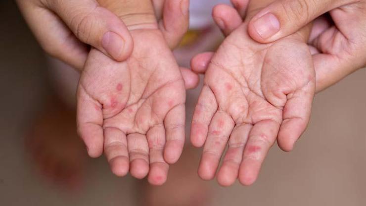 5 Yaş Altı Çocuklarda Daha Sık Görülüyor Belirtileri Arasında Ateş, Vücut Döküntüleri, Boğaz Ağrısı Var... Bu Hastalığa Dikkat