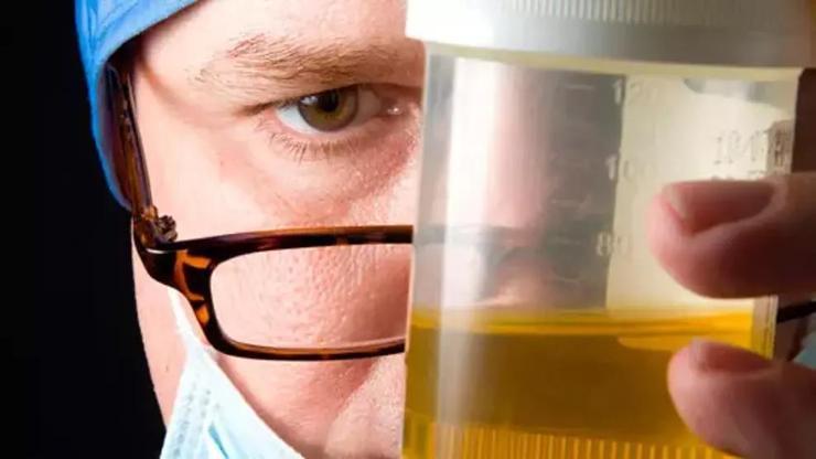 İdrar Rengi Koyuysa Vücudunuz Alarm Veriyor Demektir İşte Sebebi