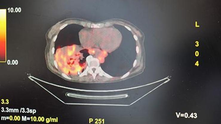 AKCİĞER KANSERİ ALARMI Hiç Sigara İçmeyenlerde de Akciğer Kanseri Vakaları Arttı Uzmanlar Sebebini Açıkladı Akciğer Kanserinde Sinsi Tehlikelere Dikkat