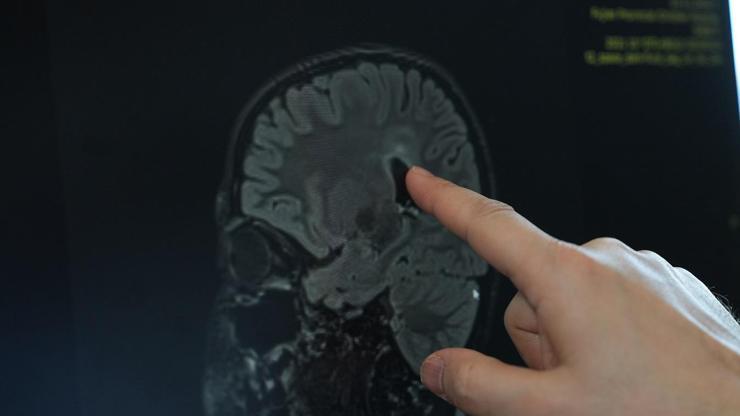 Vücuttaki Aşırı Kasılmaların Nedeni Bu Hastalık Olabilir Hareket Kabiliyetini Bozuyor; BEYİN FELCİ...