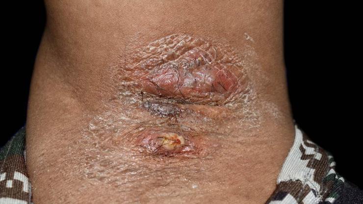 KÖPEK MEMESİ HASTALIĞINA DİKKAT Koltuk Altı, Kasık ve Meme Altı Gibi Bölgelerdeki Ağrılı Nodüller Köpek Memesi Hastalığının Belirtisi Olabilir Köpek Memesi Hastalığı Nedir