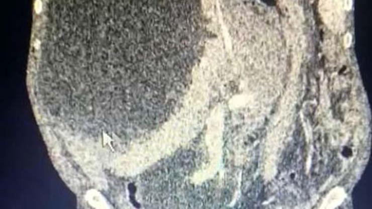 Karnında Şişkinlik Ve Ağrı Şikayetiyle Hastaneye Gitti Karaciğerinden 90 Santimetrelik Kedi-Köpek Kisti Çıkarıldı