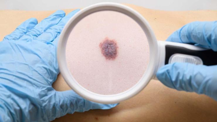 Cilt Kanserinden Korunmanın Yolları