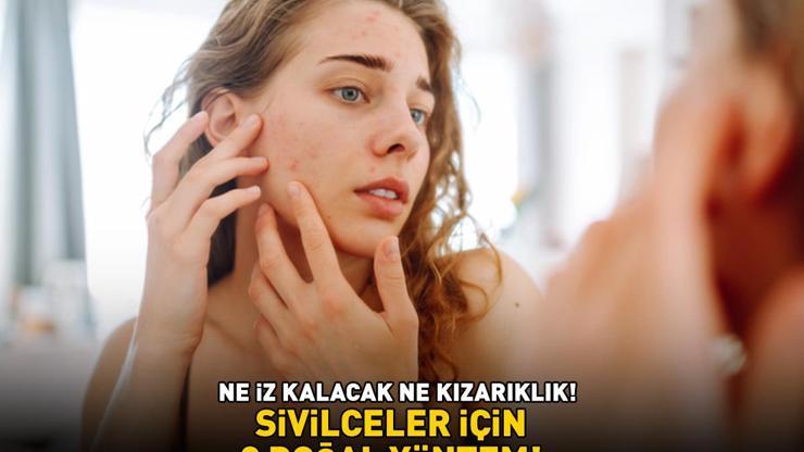 SİVİLCELER İÇİN ETKİLİ 3 DOĞAL YÖNTEM 10-15 dakika bekletmek yetiyor Ne iz kalacak ne de kızarıklık