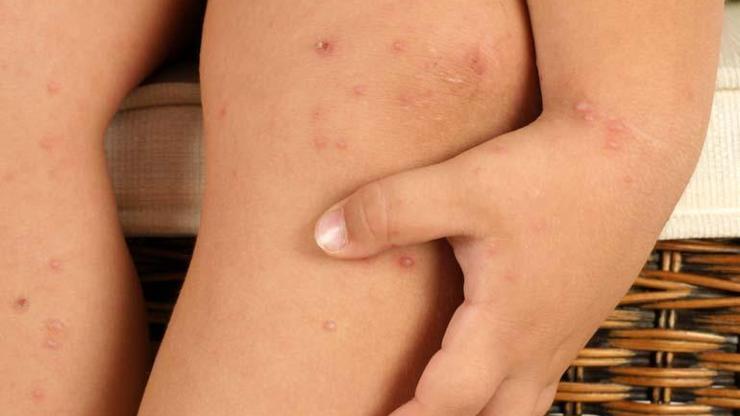 BELİRTİLERE DİKKAT Sıcak Havalar Çocuklarda Döküntü Riskini Artırıyor