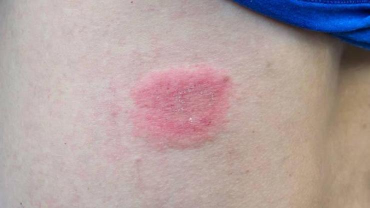 Yaz Aylarında Mantar Enfeksiyonları: Sıcak Havalarda Dikkat Edilmesi Gerekenler ve Alınacak Önlemler