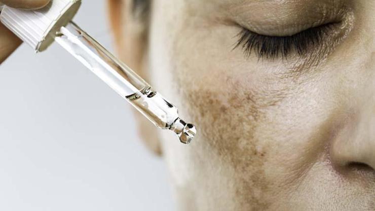 Cilt Lekeleri Neden Olur Cilt Lekeleri ve Tedavi Yöntemleri İle İlgili Tüm Merak Edilenler